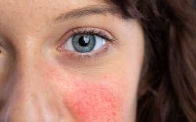 Last van couperose? Zo ondersteun je je huid van binnenuit en buitenaf!